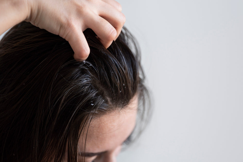 Dandruff — Causes and How to Solve It: Restoring Scalp Balance