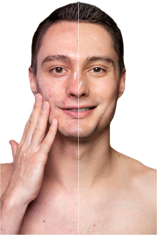 HANDGEMAAKTE CRÈME VOOR EEN ACNE- EN PROBLEMATISCHE HUID, 40 ml